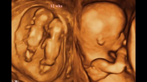 The fetal anomaly scan .